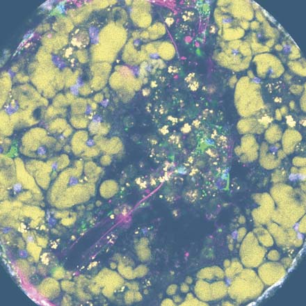 Disease modeling cells